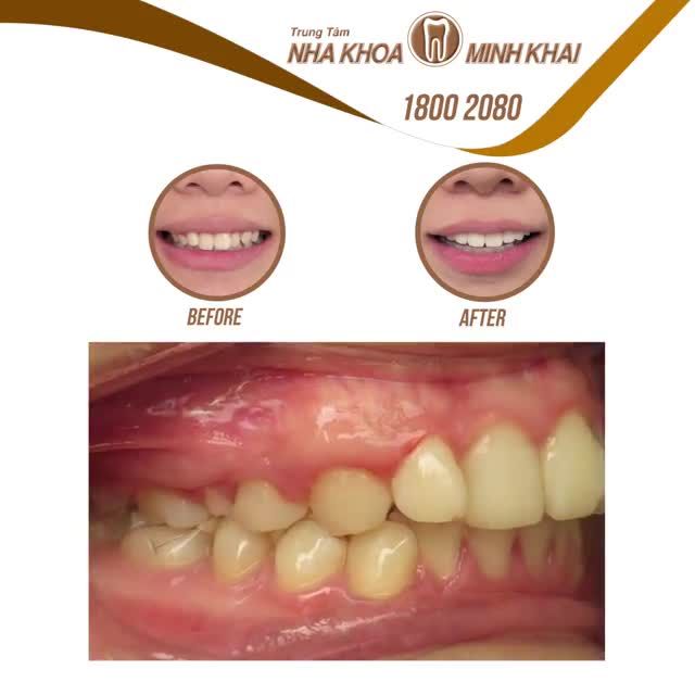 Khách hàng sinh năm 1996 đến với Nha Khoa Minh Khai với mong muốn chỉnh lại hàm răng lệch lạc.