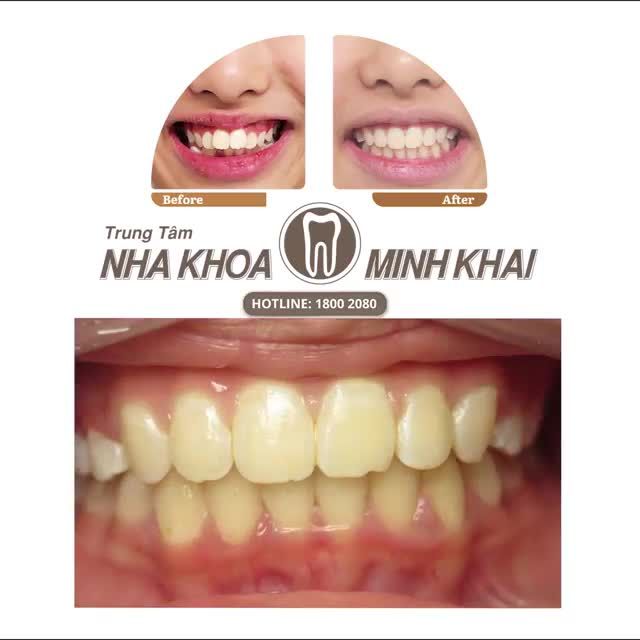 Khách hàng sinh năm 2004 đến Nha Khoa Minh Khai với mong muốn chỉnh hô.