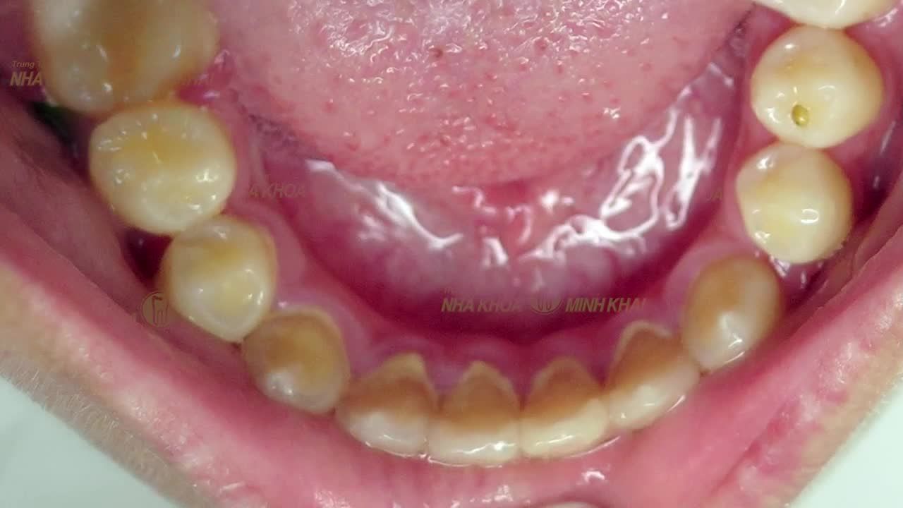 Khách hàng sinh năm 2006  chỉnh nha trong thời điểm “vàng” – độ tuổi răng và xương còn đang trong giai đoạn phát triển.