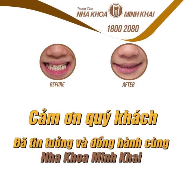 Khách hàng sinh năm 2006 đến với Nha Khoa Minh Khai với mong muốn chỉnh lại răng đều.