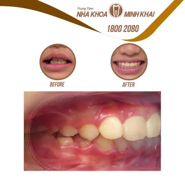 Khách hàng sinh năm 2007 đến với Nha Khoa Minh Khai trong tình trạng khớp cắn sâu khá nặng.