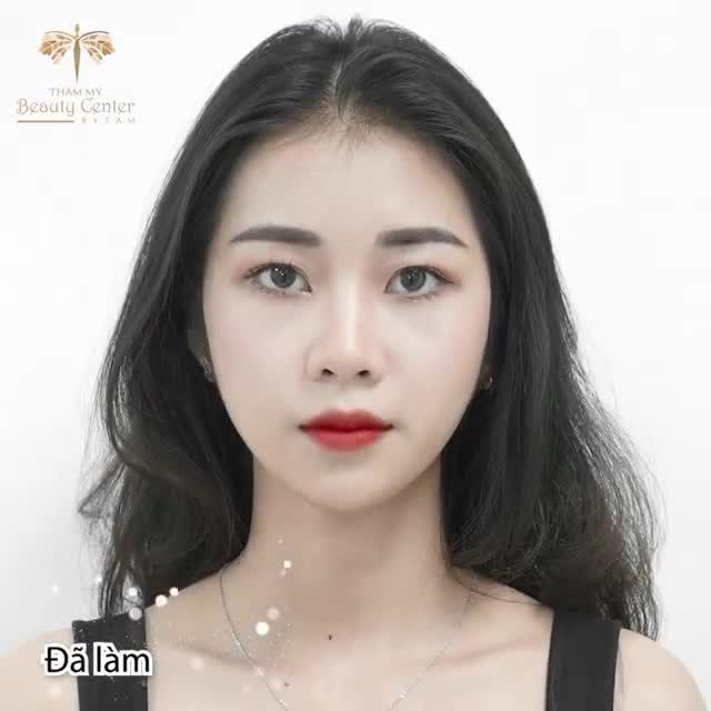 Khách hàng sử dụng dịch vụ Botox thon gọn hàm và Filler cằm được lột xác với hình ảnh tươi mới và thu hút hơn!
