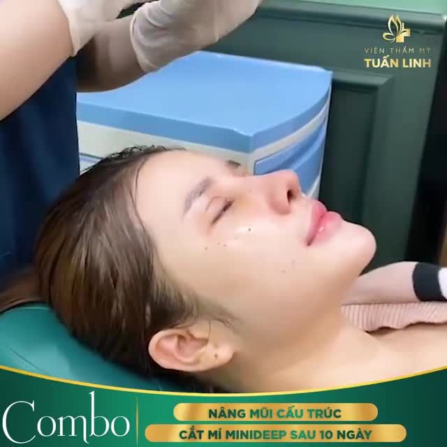 KHOE TRỌN COMBO: nâng mũi cấu trúc + cắt mí Mini deep sau 10 ngày phẫu thuật tại CLIP bên dưới
