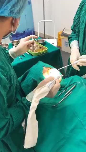 KHỞI ĐỘNG TUẦN MỚI CÙNG CA CẮM 2 IMPLANT KHẮC PHỤC TÌNH TRẠNG MẤT 2 RĂNG HÀM TRÊN CHO KH