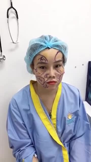 Lắng nghe bác sĩ Đông Á đo vẽ  phân tích về cấy mỡ mặt