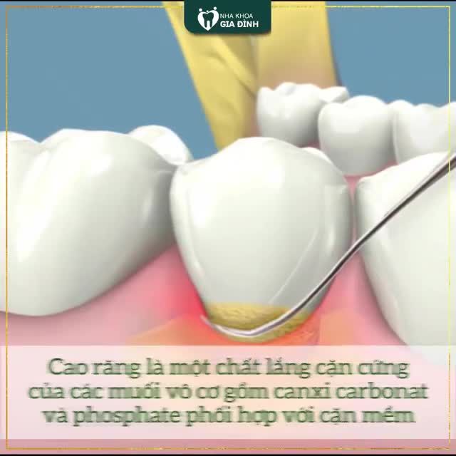 LẤY CAO RĂNG ĐỊNH KÌ CÓ QUAN TRỌNG KHÔNG