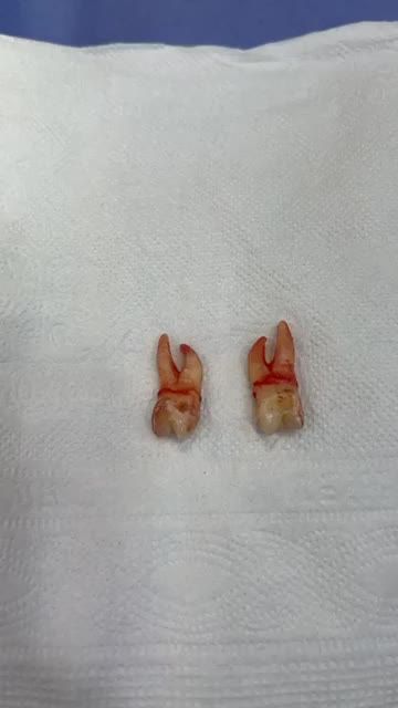 Loại bỏ răng khôn nhẹ nhàng êm ái như đi nghỉ dưỡng