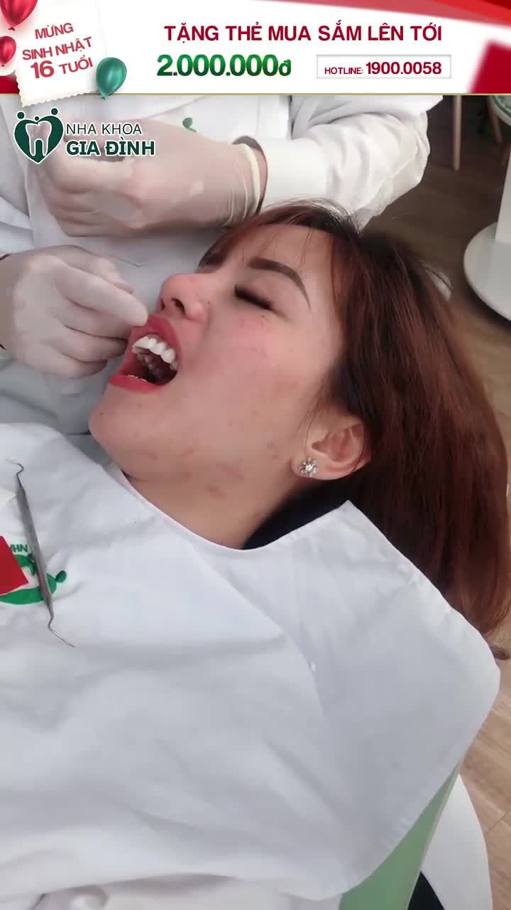 LỘT XÁC NGOẠN MỤC CÙNG PHƯƠNG PHÁP DÁN SỨ VENEER