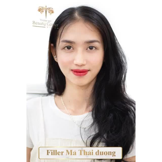 MẶT ĐẦY ĐẶN- NÉT TƯƠI XINH với Filler đầy hóp má, thái dương.