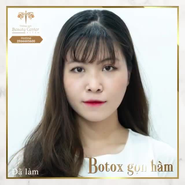 Mặt nhỏ nhắn, nét xinh xắn Đó là kết quả của Botox thon gọn hàm tại Tấm.