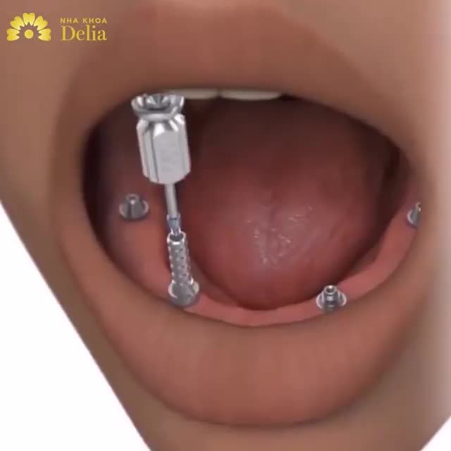 MẤT RĂNG DO TAI NẠN