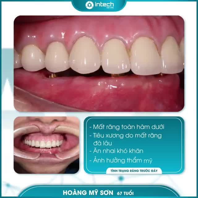 MẤT RĂNG TOÀN HÀM DƯỚI SAU TRỒNG RĂNG IMPLANT SẼ NHƯ THẾ NÀO