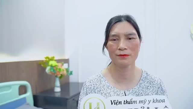Mắt sụp mí bẩm sinh cả 2 mắt nhưng chỉnh sửa chưa đúng kỹ thuật dẫn đến lỗi hỏng khắc phục như thế nào tại Dr.Hải Lê