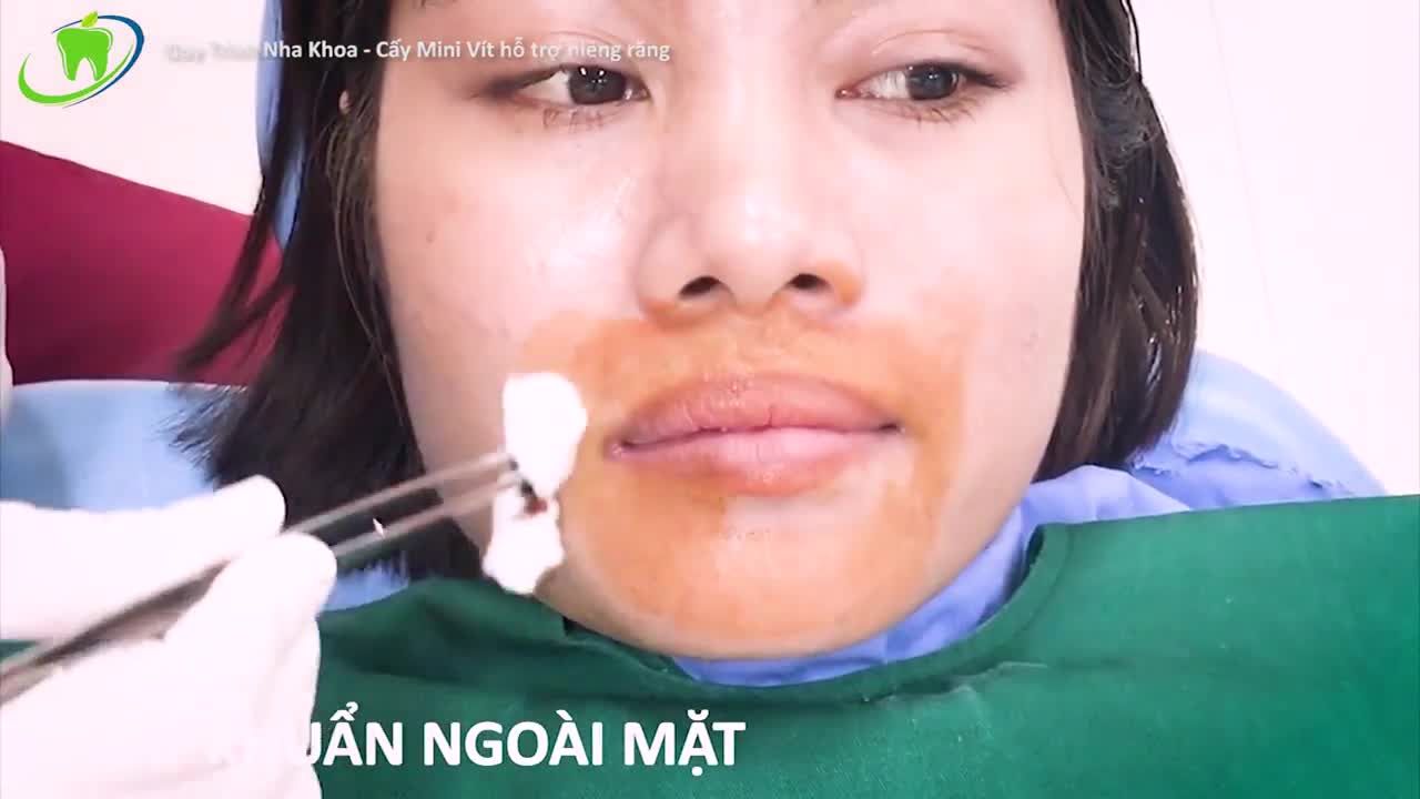 MINIVIT CHỈNH NHA LÀ GÌ? VÌ SAO PHẢI CẤY MINIVIT