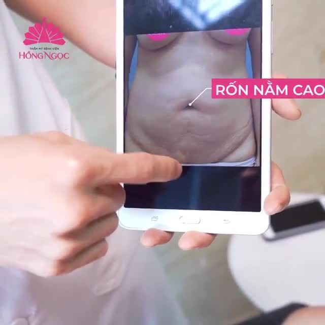 MỠ THỪA - DA CHÙNG NHÃO - CHẢY XỆ SAU SINH....VÀ CÁI KẾT SAU 20 NGÀY HÚT MỠ TẠO HÌNH