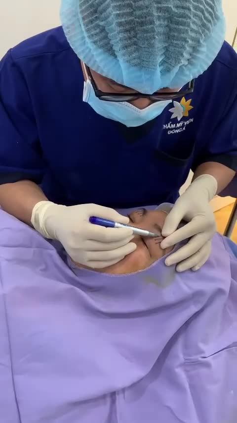 Mỡ thừa nhiều, da chùng, sụp mí khiếp cho tầm nhìn của chị em bị che khuất, đôi mắt trở nên u buồn, mệt mỏi