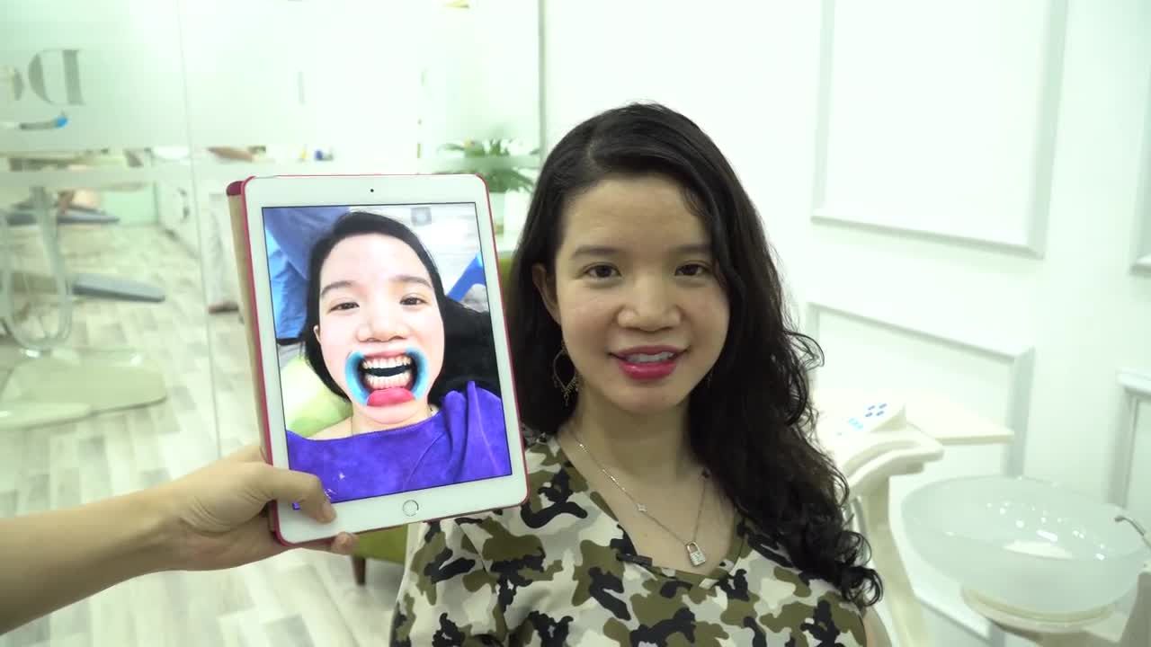 Mong muốn sở hữu vẻ ngoài ngày càng trẻ đẹp, chị Diệu Liên (Hà Nội) đã trao gửi niềm tin vào Nha Khoa Thẩm Mỹ Quốc Tế Delia để "trùng tu" hàm răng của mình