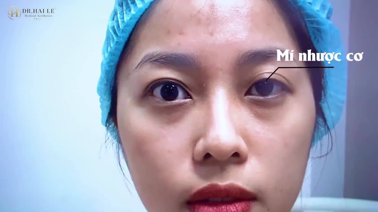Một ca cắt mí siêu khó nhưng kết quả siêu đẹp  Kết quả Chỉnh hình mắt sụp mí bẩm sinh tại cơ sở HCM 10 người xem thì 9 người phải ồ lên vì ngạc nhiên