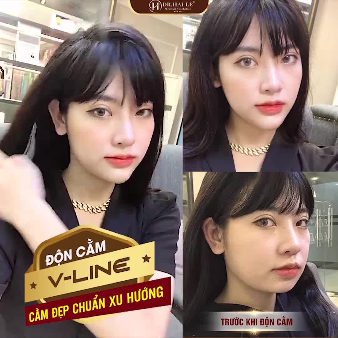 Một phụ nữ toàn diện là: Sáng diện, trưa diện, chiều diện, tối diện…và lúc nào cũng phải thật diện, thật xinh đẹp nha cả nhà. Khoe kết quả độn cằm V-line đẹp xuất sắc tại Dr.Hải Lê