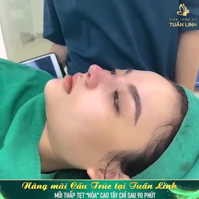 MŨI BẠN BỊ: - Thấp tẹt, cánh mũi to bè. - Lựa chọn phương pháp tiêm filler nhưng không cải thiện được nhiều.