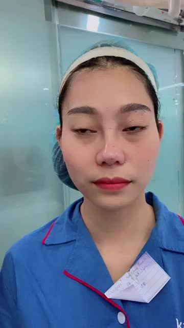 MŨI TẸT gần như không có sóng, ĐẦU MŨI TO khiến gương mặt kém sang