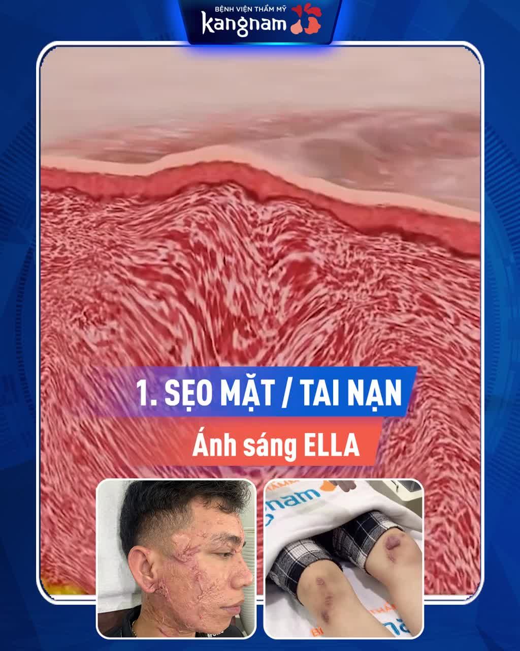 Muốn XÓA SẸO LỒI / SẸO MÔI? Phải chọn ĐÚNG CÔNG NGHỆ!