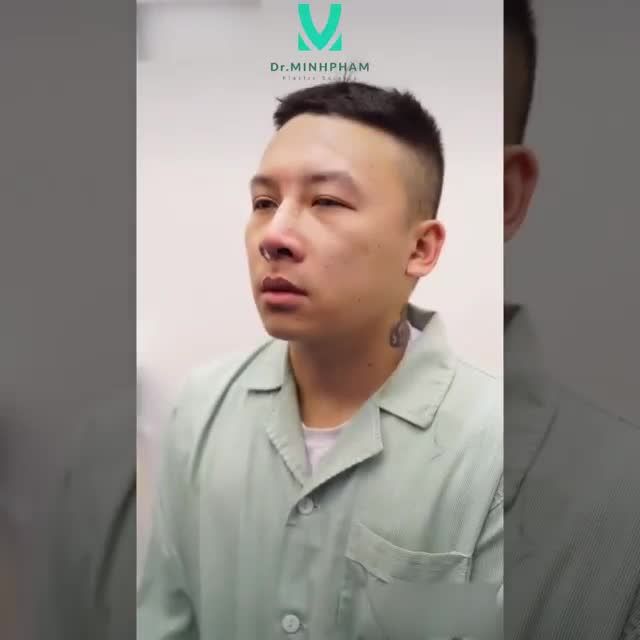 Nâng mũi ME SHAPE- Độc quyền Dr Minh Phạm108: