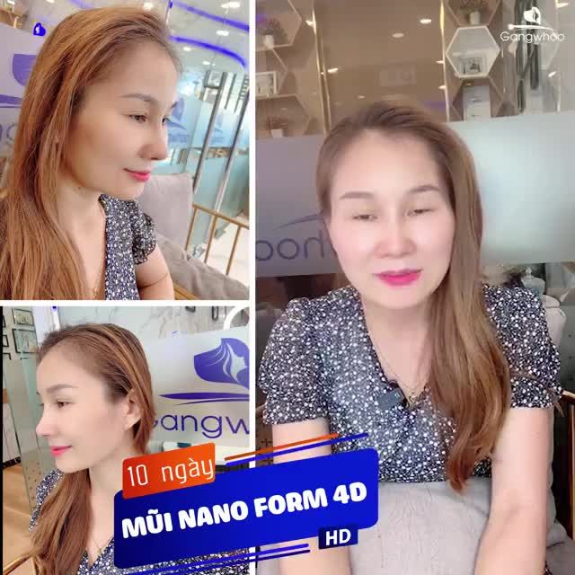NÂNG MŨI NANOFORM 4D – SỞ HỮU NGAY SỐNG MŨI SỌC DỪA