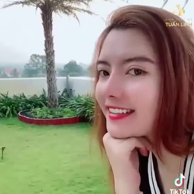 NÂNG MŨI SIÊU CẤU TRÚC VÀO PHOM ĐẸP TỰ NHIÊN SAU 5 THÁNG.