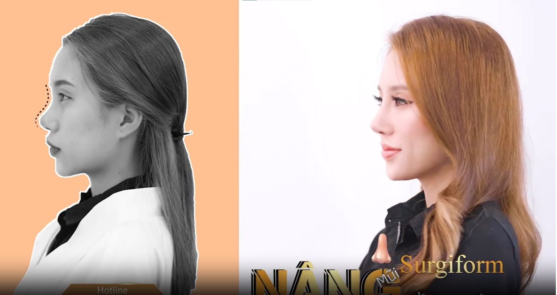 Nâng mũi Surgiform-Nâng thần thái-Đẹp hài hòa