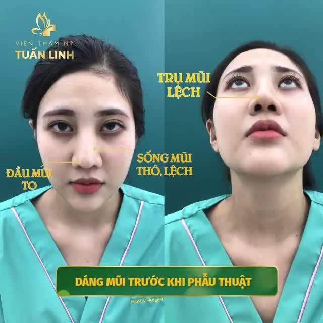 NÂNG MŨI TÁI CẤU TRÚC SURGIFORM!