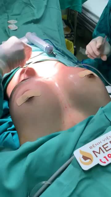 Nâng vòng một túi Mentor 275cc