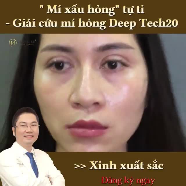 Nếu bạn đang có ý định thực hiện Sửa mí lỗi hỏng sau phẫu thuật lần 1,2.3, n lần... không thành công bạn nhất định không thể bỏ qua video: