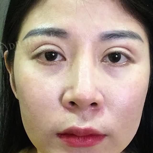 Nếu mắt bạn đang gặp phải tình trạng mí lỗi hỏng sau PT không thành công