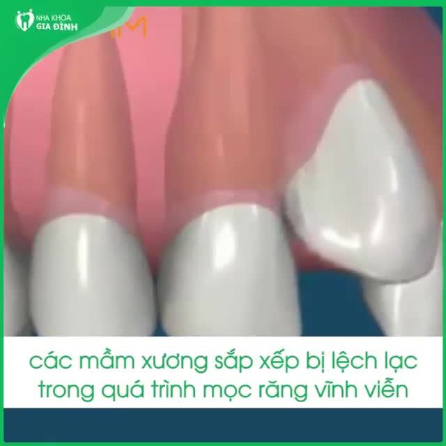 NGUYÊN NHÂN KHIẾN RĂNG MỌC LỆCH VÀ CÁCH KHẮC PHỤC