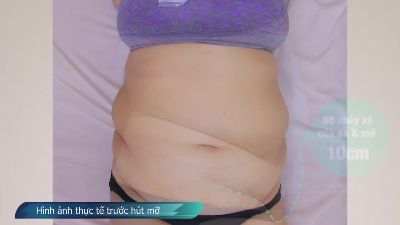 Những hình ảnh về quá trình thay đổi thực tế của Chị Khách hàng (39 tuổi) trước và sau ca thực hiện Hút mỡ tạo dáng thẩm mỹ