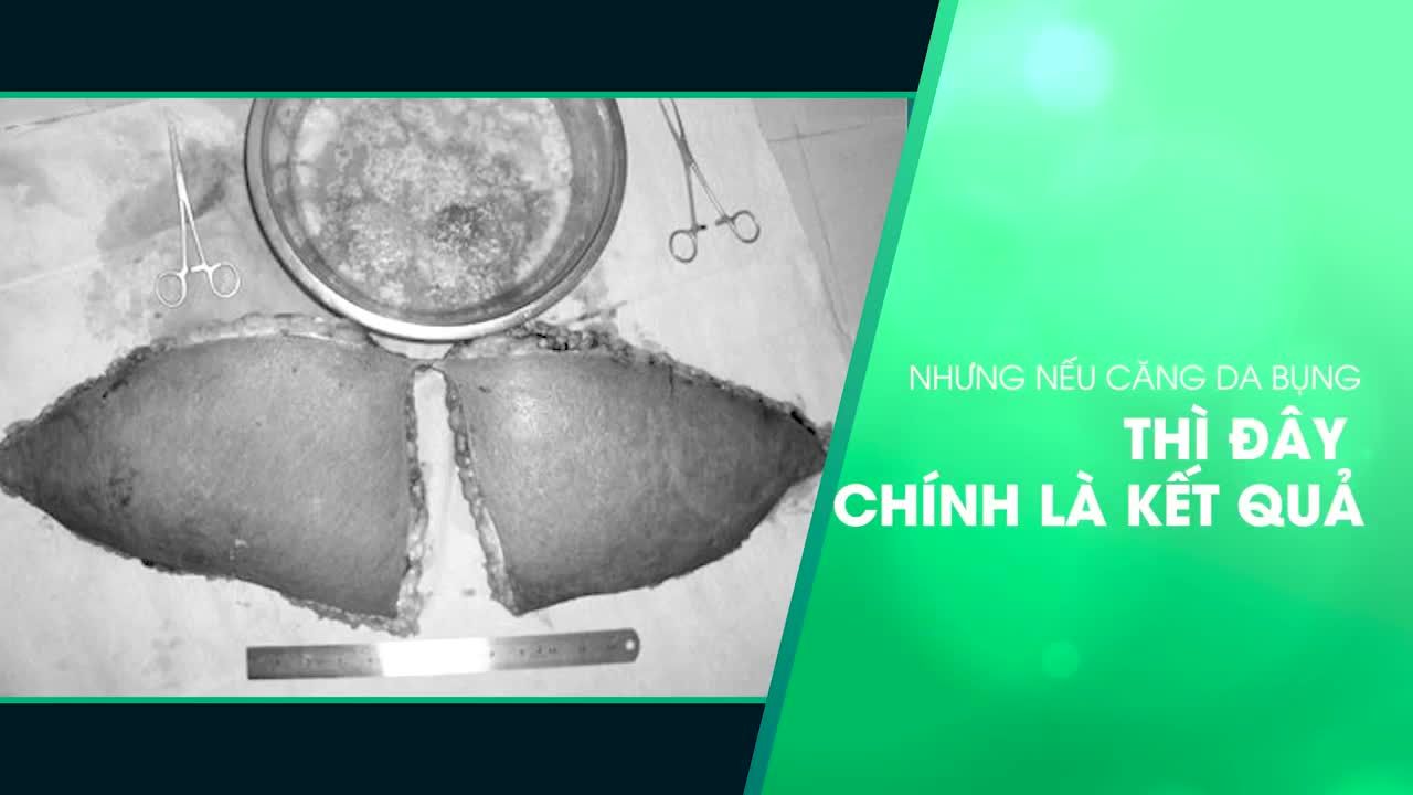 Những thắc mắc liên quan đến vấn đề giải quyết mỡ thừa, da thừa thế nào nếu không cắt bỏ đối với phương pháp hút mỡ tạo dáng thẩm mỹ, tất cả sẽ được Bác sĩ Lương Ngọc giải đáp cụ thể trong video bên dưới.