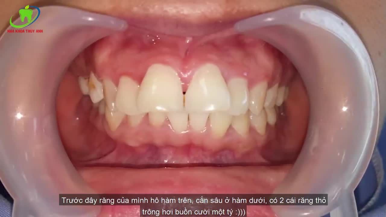 NIỀNG RĂNG HÔ, LỆCH LẠC TRẢ GÓP CHỈ TỪ 1 TRIỆU/THÁNG