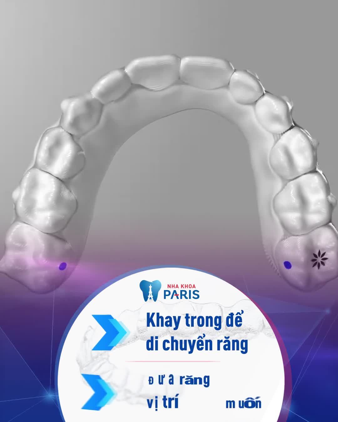 NIỀNG RĂNG INVISALIGN - TIÊU CHUẨN PHÁP
