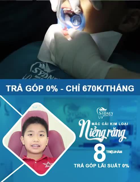 NIỀNG RĂNG MẮC CÀI KIM LOẠI -  Di chuyển răng chuẩn xác, đúng lộ trình
