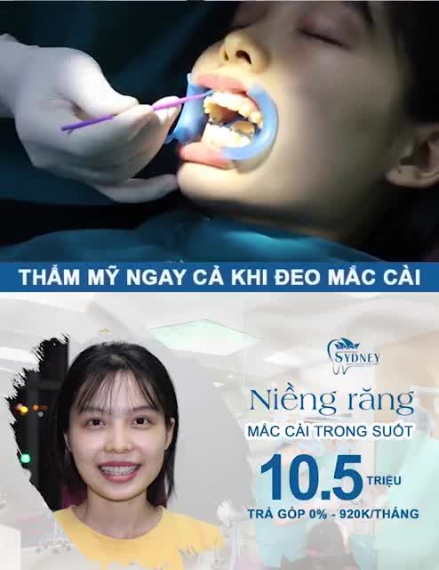 NIỀNG RĂNG MẮC CÀI PHA LÊ TRONG SUỐT