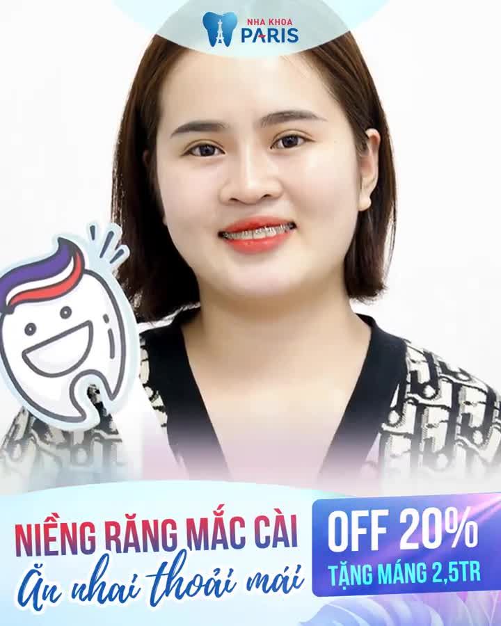 NIỀNG RĂNG OFF 25% - HÈ VỀ SALE HẾT Ý