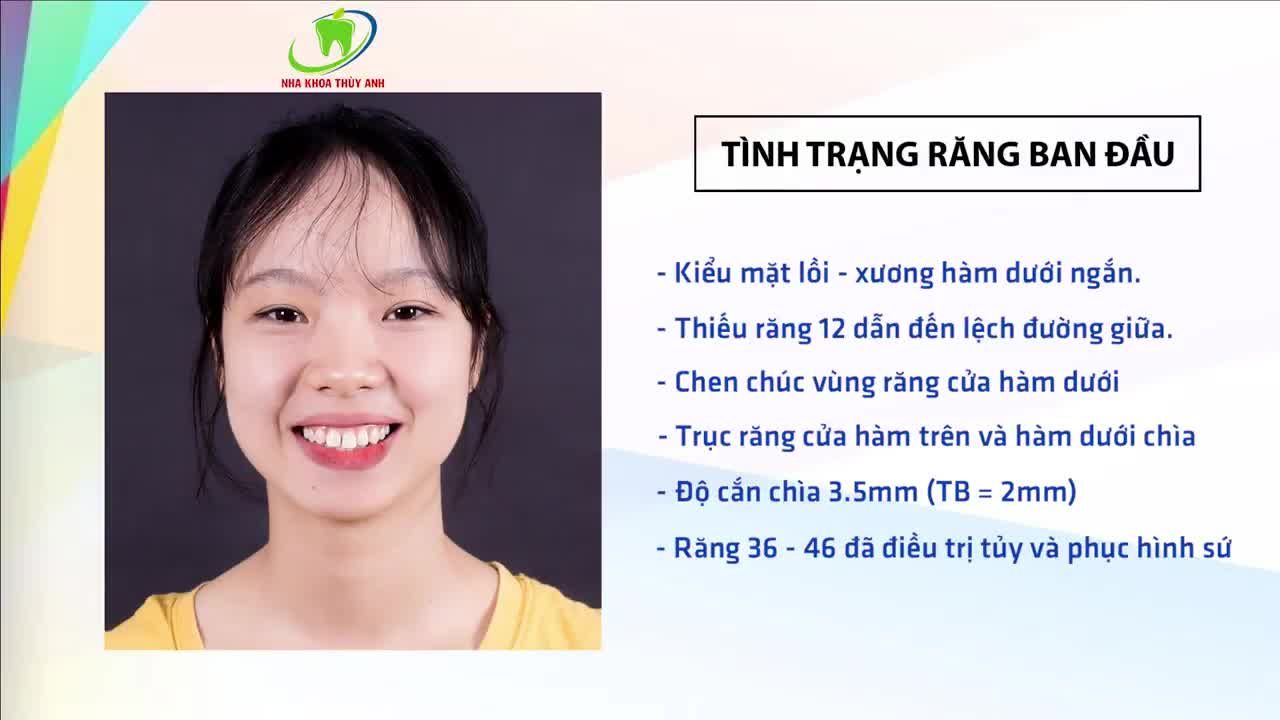 NIỀNG RĂNG - PHƯƠNG PHÁP GIÚP BẠN CÓ ĐƯỢC NỤ CƯỜI HẰNG MONG ƯỚC