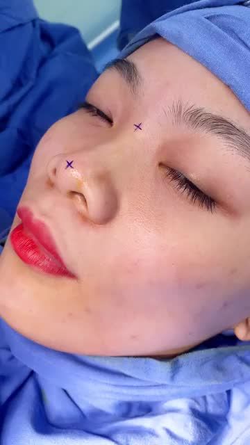 Nữ KH đến từ sáng sớm và nhận luôn suất Nâng mũi cấu trúc 4D ưu đãi 50% 35TR - chỉ còn 17.5TR