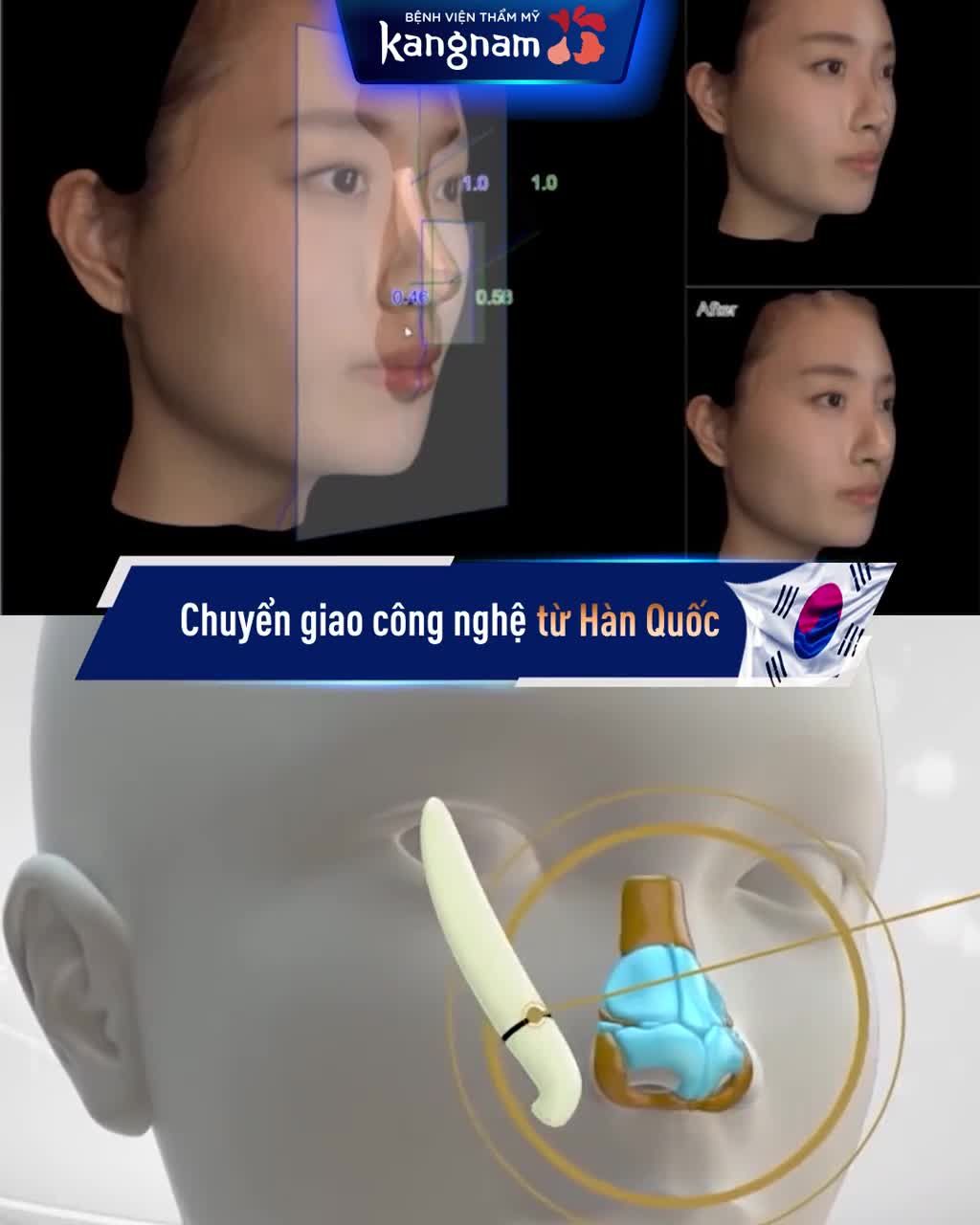 OFF tới 50% Nâng mũi chuẩn chuyên gia