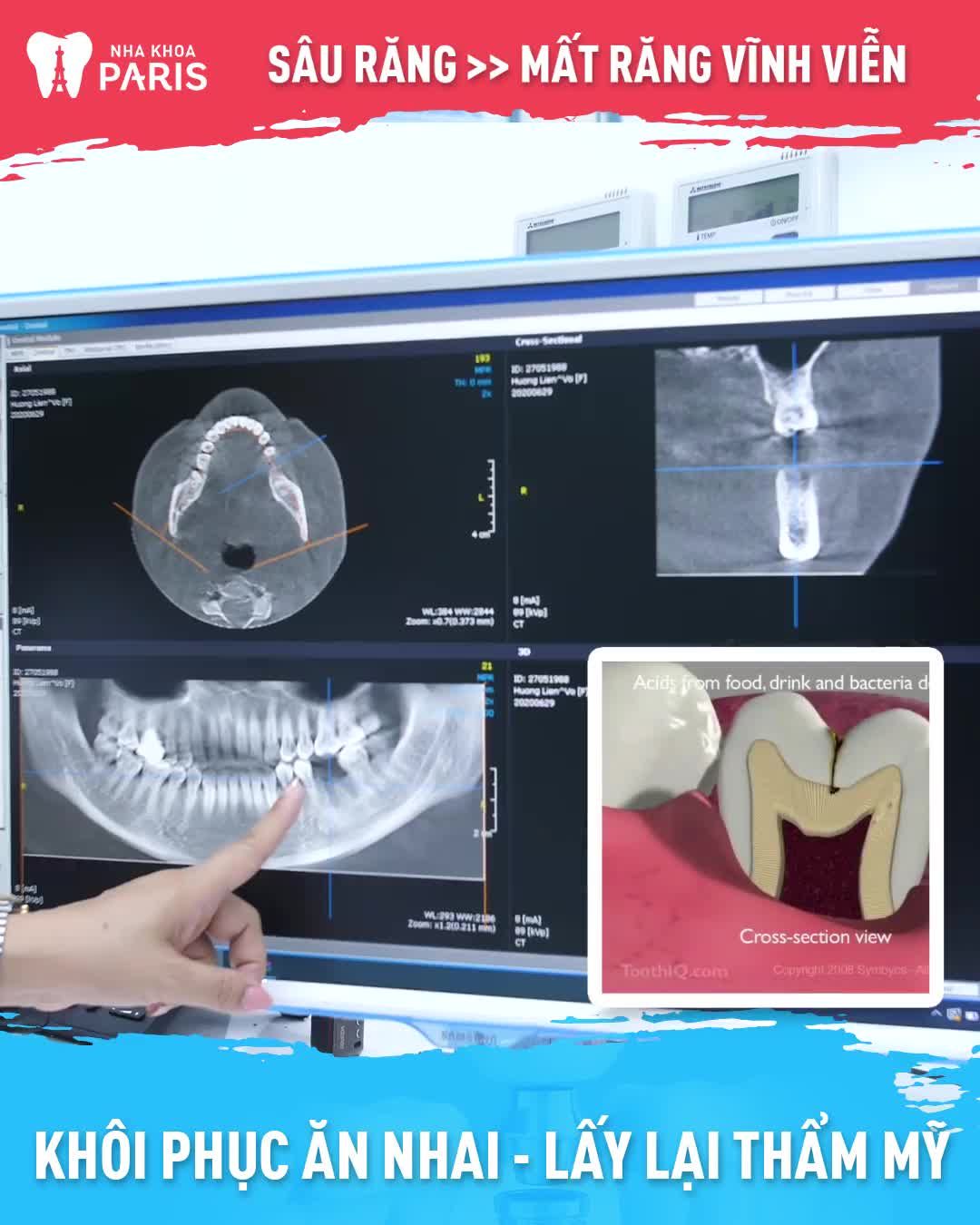 Phác đồ biết trước kết quả dựa theo phim CT Cone Beam và Scan răng 3D