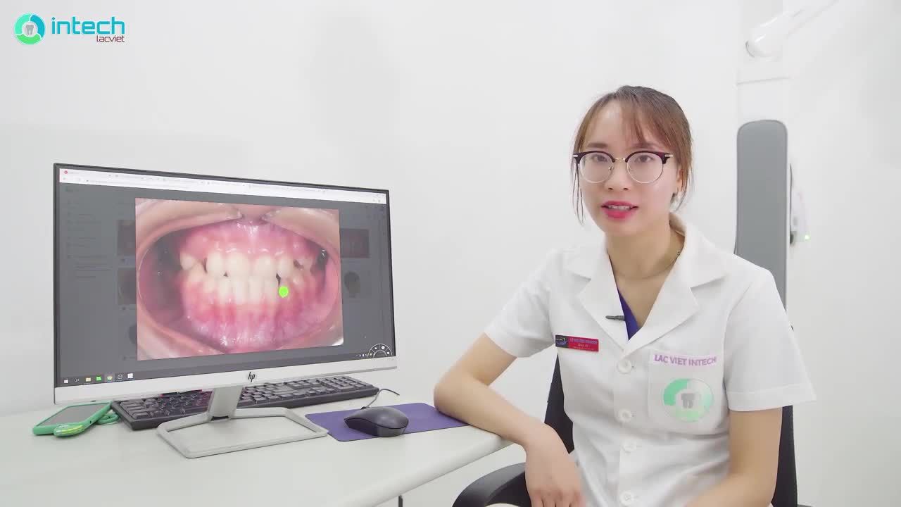 PHÂN TÍCH LÂM SÀNG- CA NIỀNG RĂNG MÓM THAY ĐỔI CHỈ SAU 2 THÁNG TẠI NHA KHOA LẠC VIỆT INTECH