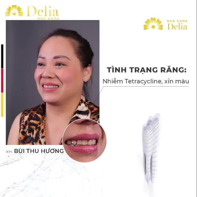 PHỤ NỮ BAO NHIÊU TUỔI NÊN THẨM MỸ RĂNG SỨ