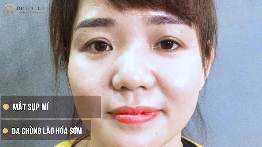"Phụ nữ là phải đẹp, cho nên xấu chỗ nào đi sửa chỗ đó... như mình sụp mí chồng động viên đi làm mí đi, mình quyết trong 2 ngày rồi 2 vợ chồng đến Dr.Hải Lê luôn "