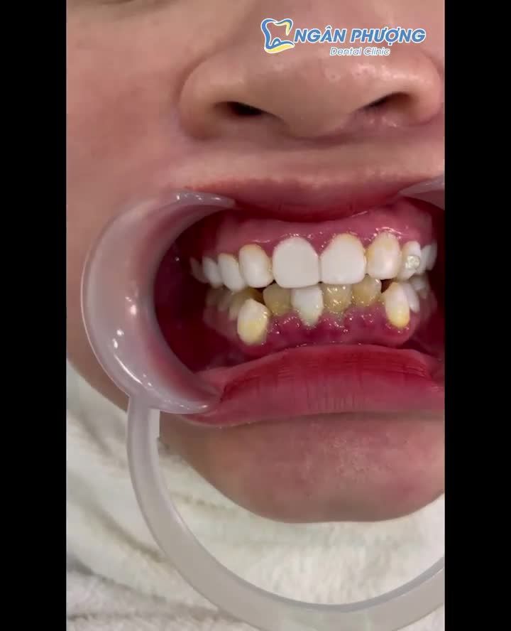 Phủ sứ nano lâu ngày đè lợi làm viêm nướu, răng to, thô và nhanh xỉn màu và gây nên tình trạng hôi miệng.